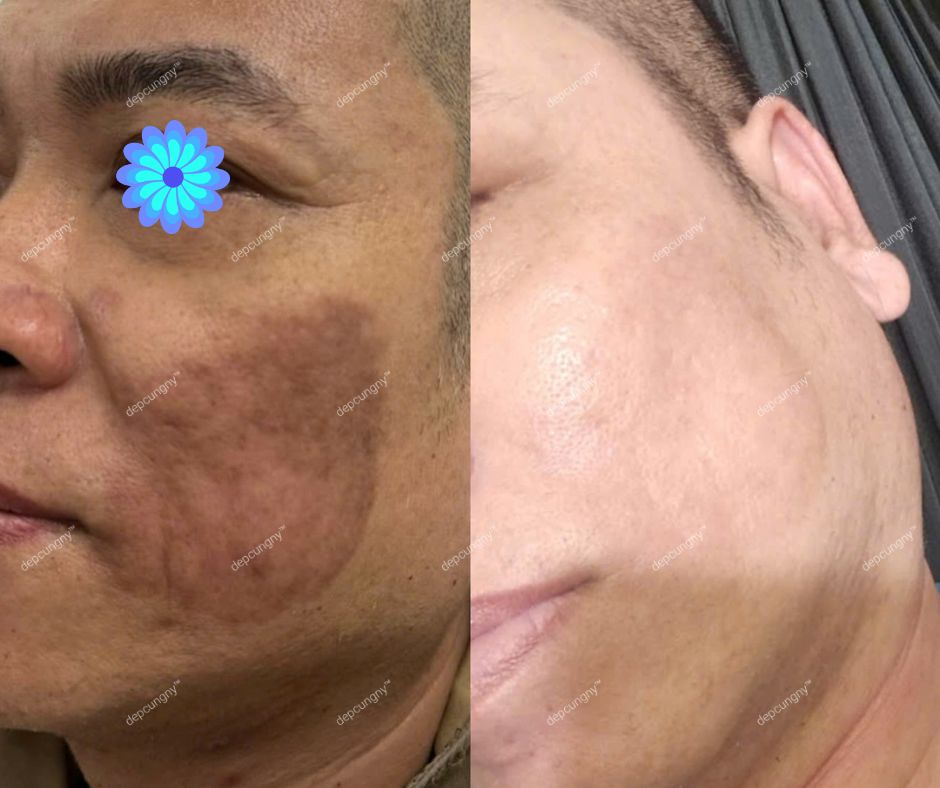 meso thâm mụn nám